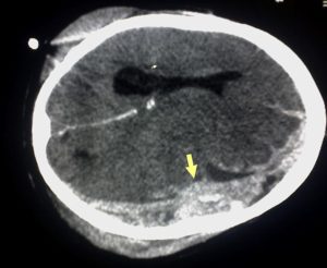 Shaken Baby Syndrome is a tragic but very preventable medical condition.